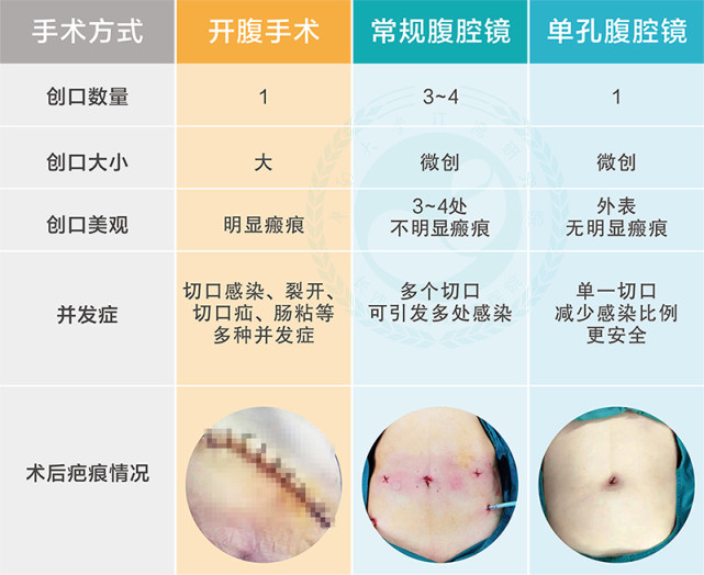 是技术更是艺术！长沙江湾医院单孔腹腔镜开创“无痕”新时代