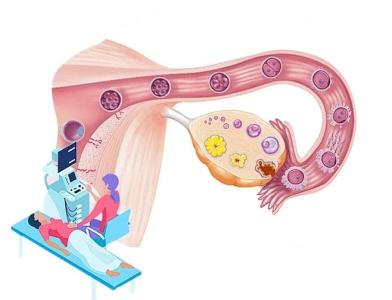 多囊卵巢综合征频发，救救女性生育力！